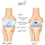 نشانه‌های اولیه آرتروز زانو